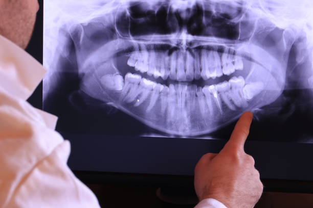 Best Emergency Wisdom Teeth Removal in Palo Alto, CA